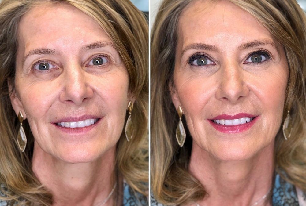 Antes/Después Clara – Bobbi Brown Lagasca
