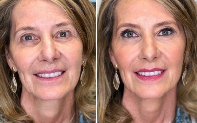 Antes/Después Clara – Bobbi Brown Lagasca